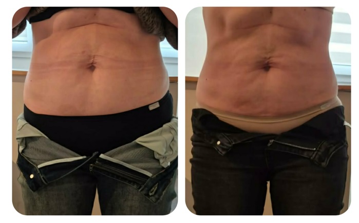 3 kezelés után – előtte