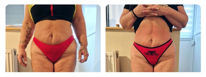 4 kezelés után – eredmény