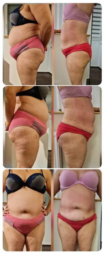 5 kezelés után – eredmény