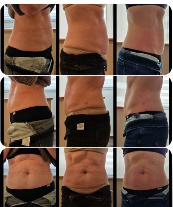 5 kezelés után – eredmény